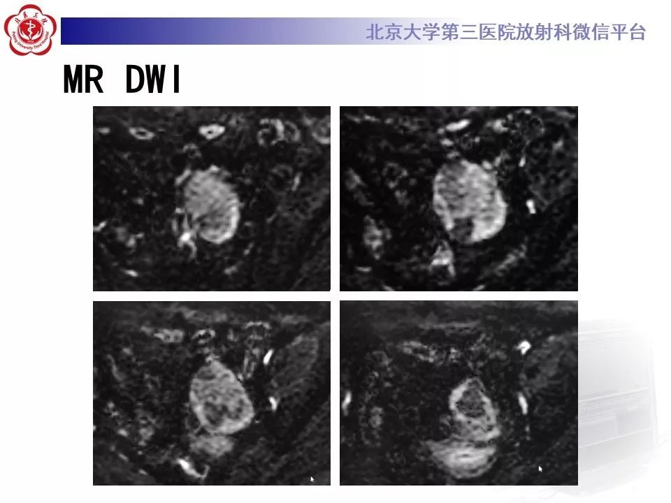 【PPT】卵巢甲状腺肿的影像