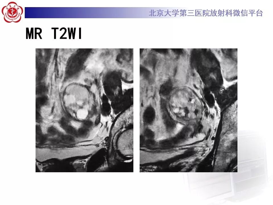 【PPT】卵巢甲状腺肿的影像