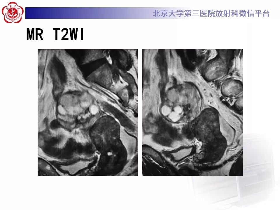 【PPT】卵巢甲状腺肿的影像