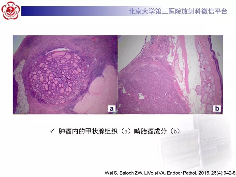 【PPT】卵巢甲状腺肿的影像