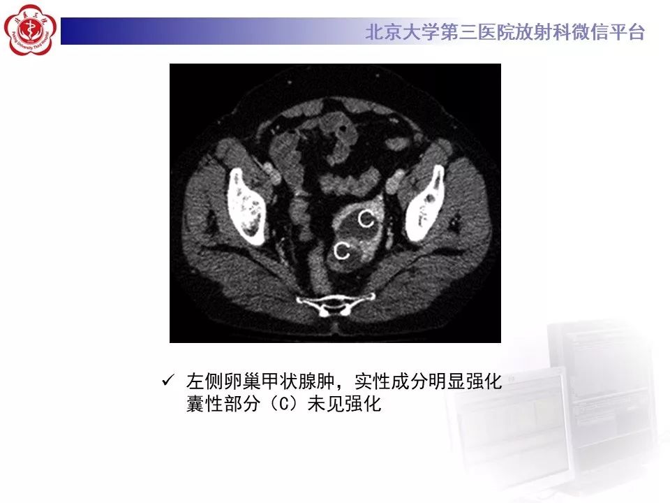【PPT】卵巢甲状腺肿的影像