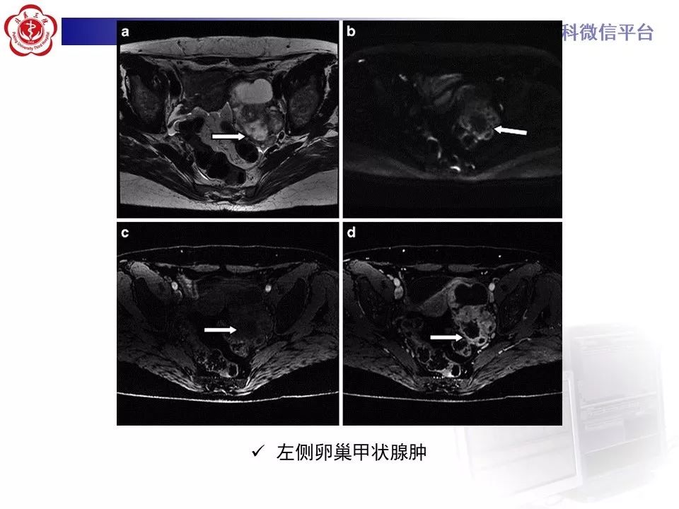 【PPT】卵巢甲状腺肿的影像