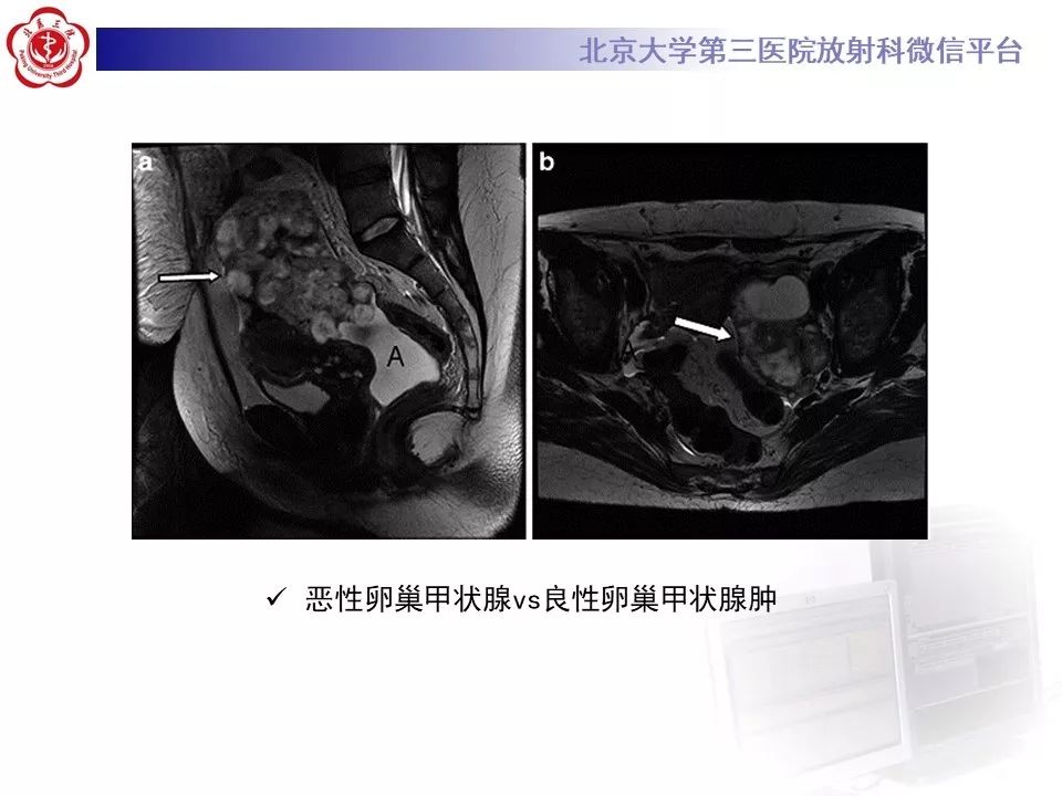 【PPT】卵巢甲状腺肿的影像