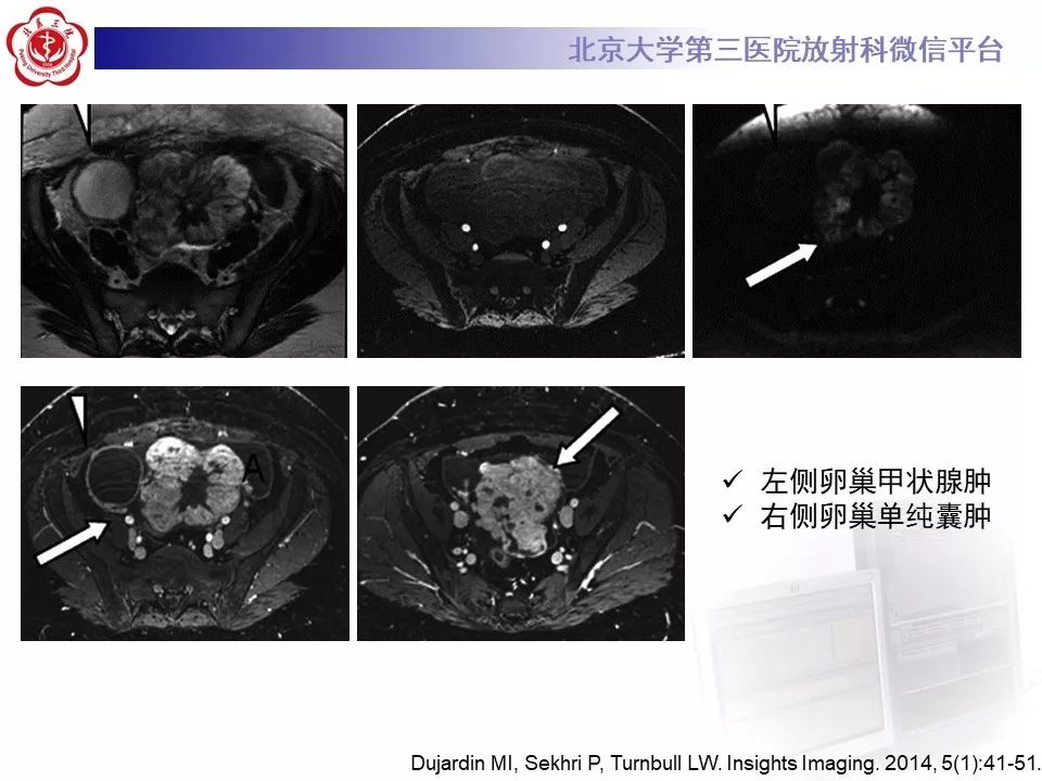 【PPT】卵巢甲状腺肿的影像