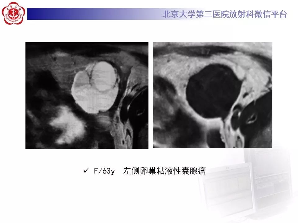 【PPT】卵巢甲状腺肿的影像