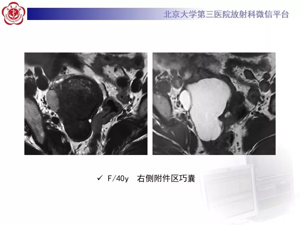 【PPT】卵巢甲状腺肿的影像