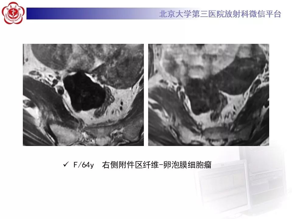 【PPT】卵巢甲状腺肿的影像