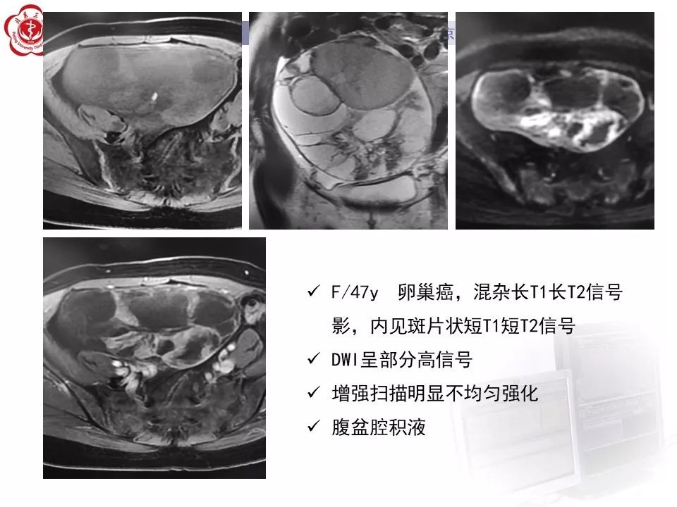 【PPT】卵巢甲状腺肿的影像