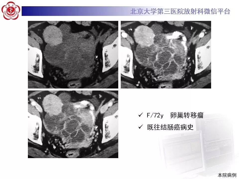 【PPT】卵巢甲状腺肿的影像