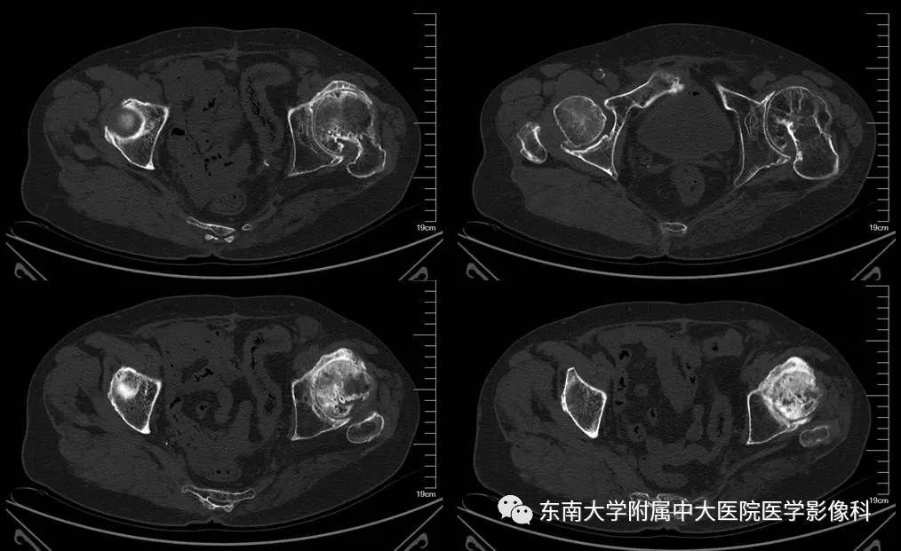 【PPT】股骨头缺血性坏死的影像