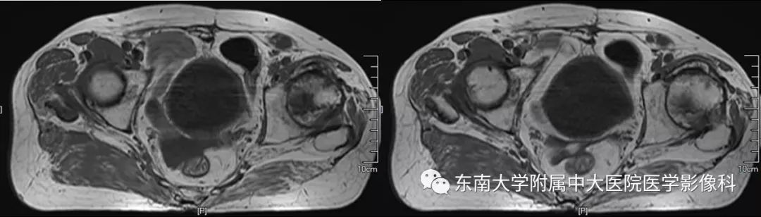 【PPT】股骨头缺血性坏死的影像