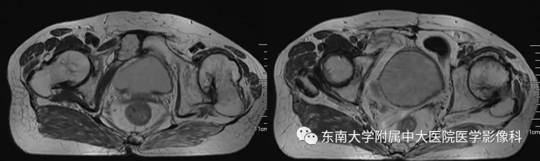 【PPT】股骨头缺血性坏死的影像