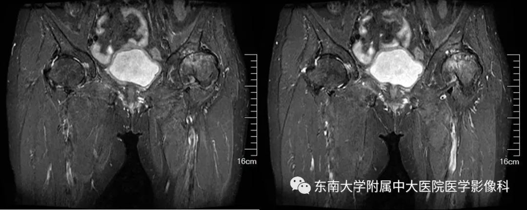 【PPT】股骨头缺血性坏死的影像