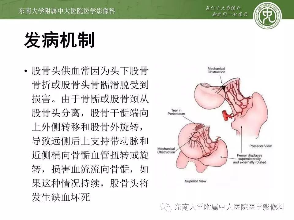 【PPT】股骨头缺血性坏死的影像