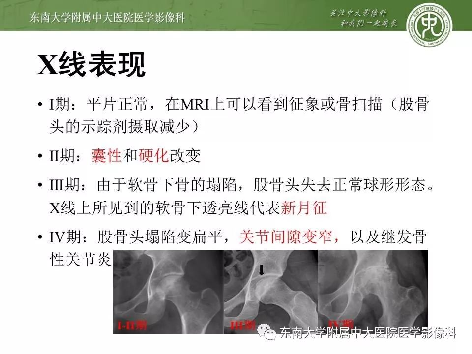 【PPT】股骨头缺血性坏死的影像