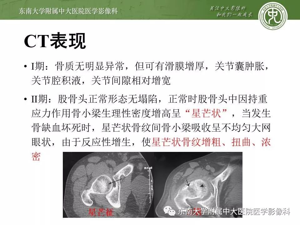 【PPT】股骨头缺血性坏死的影像