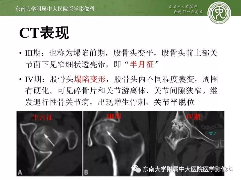 【PPT】股骨头缺血性坏死的影像