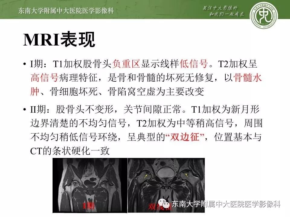 【PPT】股骨头缺血性坏死的影像