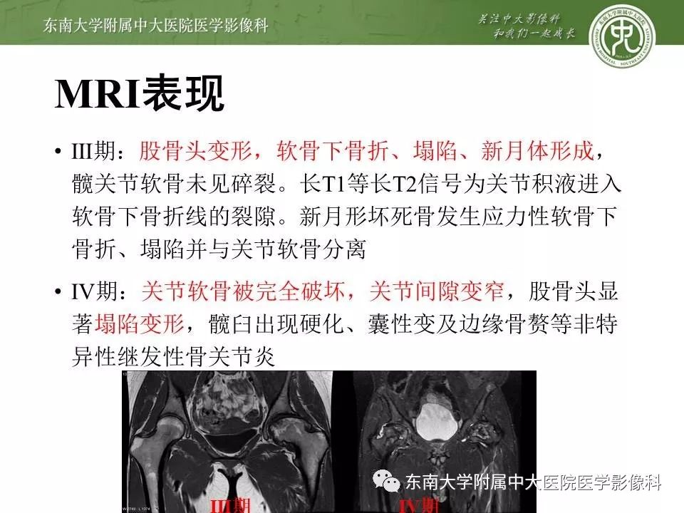 【PPT】股骨头缺血性坏死的影像