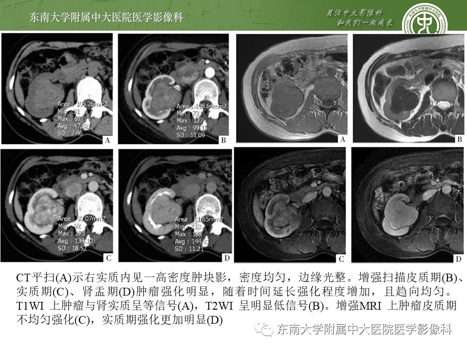 【PPT】肾脏孤立性纤维瘤