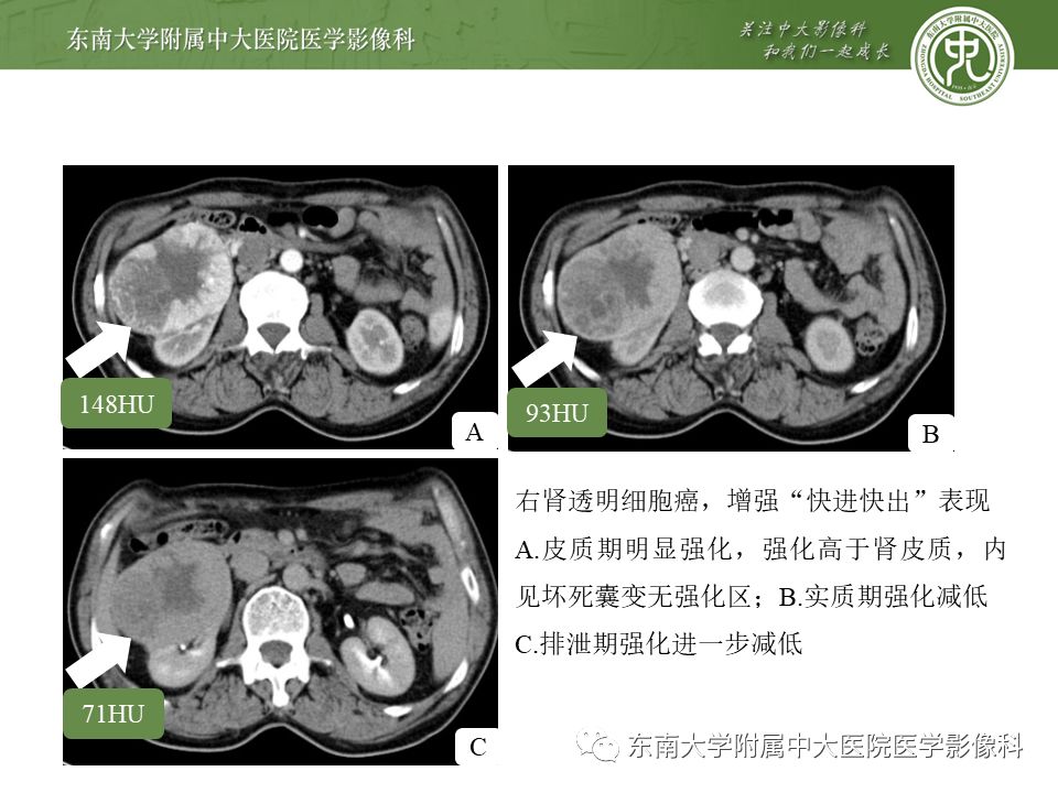 【PPT】肾脏孤立性纤维瘤