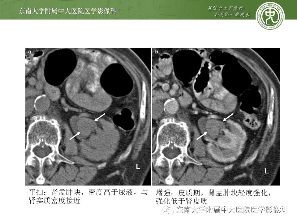 【PPT】肾脏孤立性纤维瘤