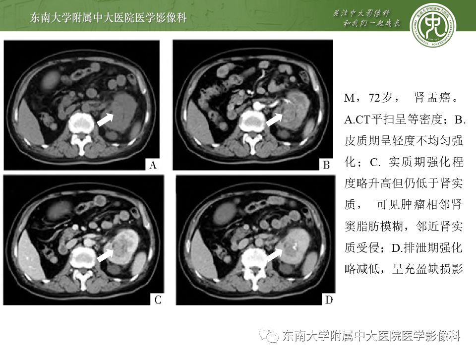 【PPT】肾脏孤立性纤维瘤