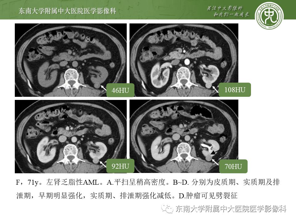 【PPT】肾脏孤立性纤维瘤
