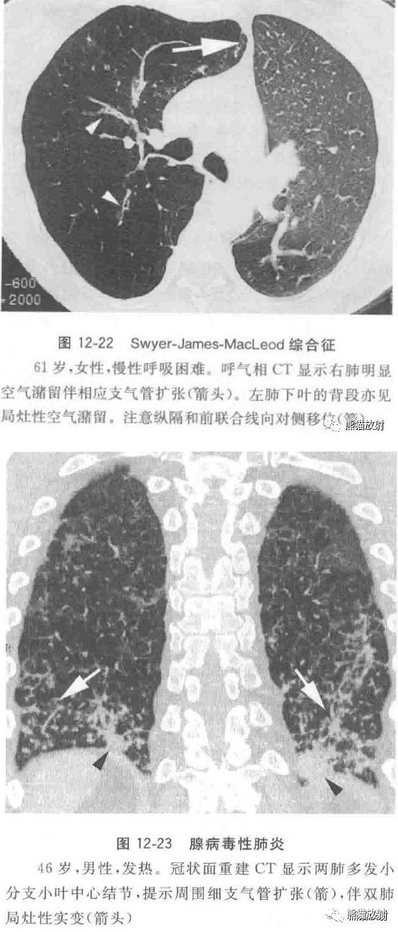病毒性肺炎临床与影像表现 病毒性肺炎临床与影像表现