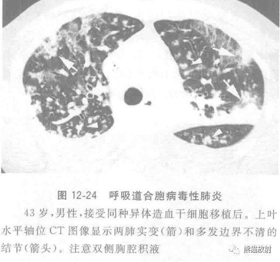 病毒性肺炎临床与影像表现 病毒性肺炎临床与影像表现