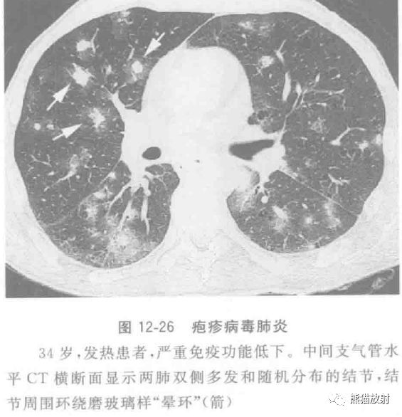 病毒性肺炎临床与影像表现 病毒性肺炎临床与影像表现