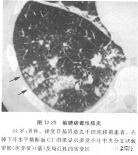 病毒性肺炎临床与影像表现 病毒性肺炎临床与影像表现