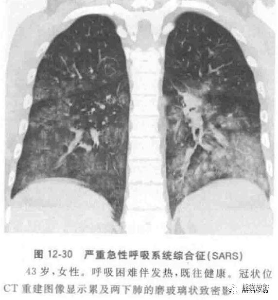 病毒性肺炎临床与影像表现 病毒性肺炎临床与影像表现