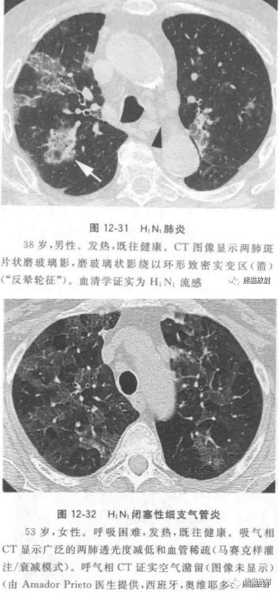 病毒性肺炎临床与影像表现 病毒性肺炎临床与影像表现