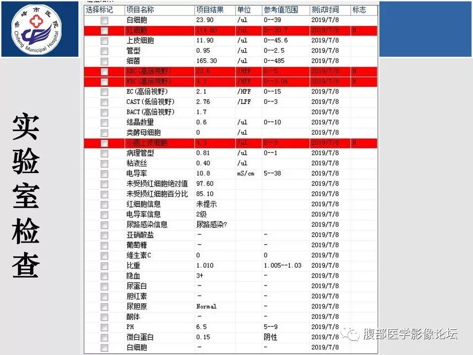 【病例】肾脏原始神经外胚层肿瘤PNET一例CT影像
