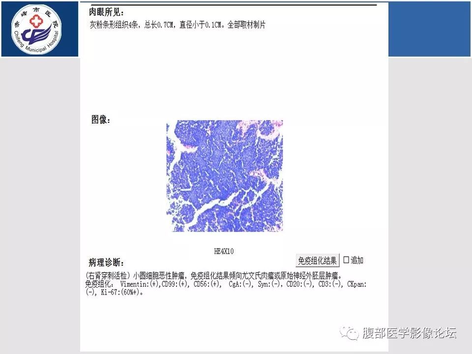 【病例】肾脏原始神经外胚层肿瘤PNET一例CT影像