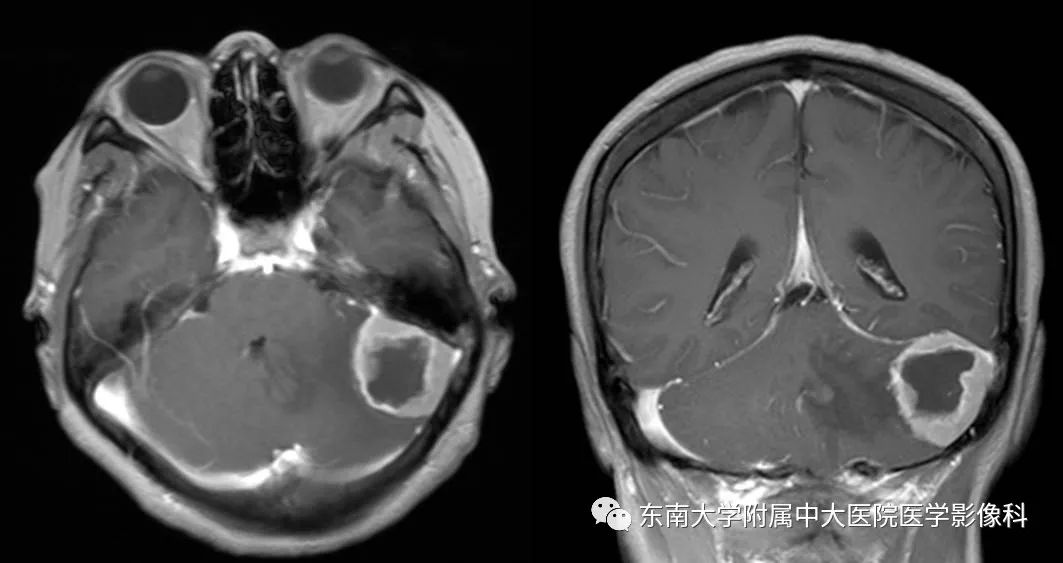 【病例】脑膜瘤伴钙化1例MR影像