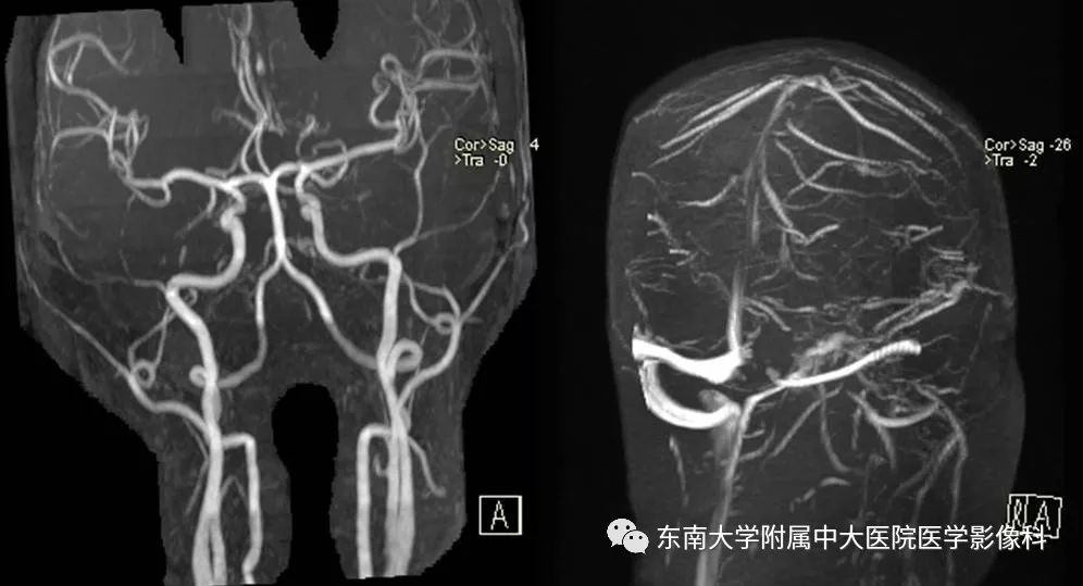【病例】脑膜瘤伴钙化1例MR影像