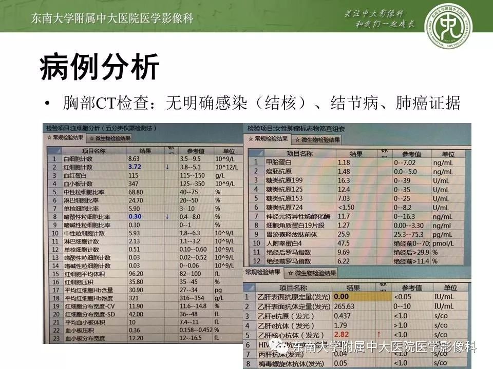 【病例】脑膜瘤伴钙化1例MR影像