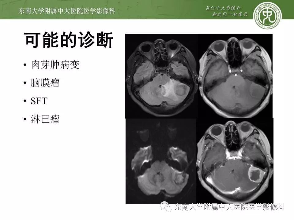 【病例】脑膜瘤伴钙化1例MR影像