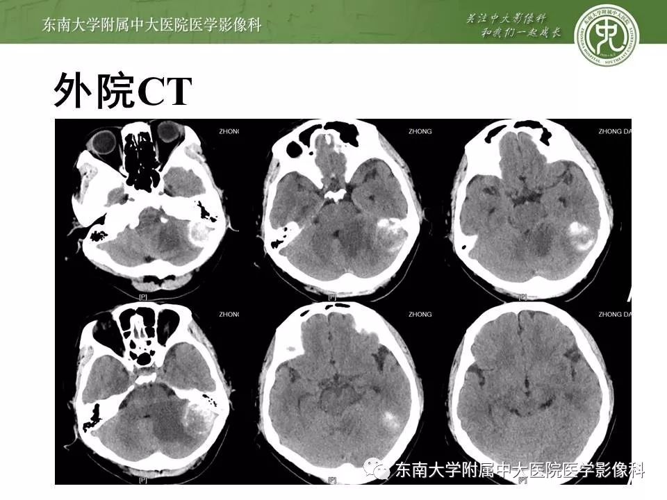 【病例】脑膜瘤伴钙化1例MR影像