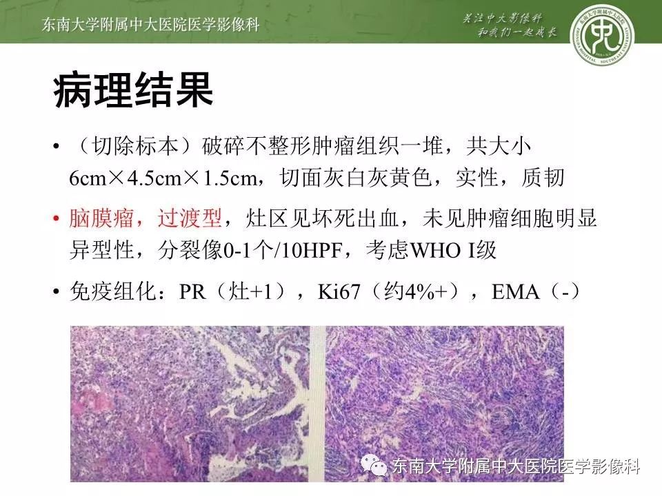【病例】脑膜瘤伴钙化1例MR影像
