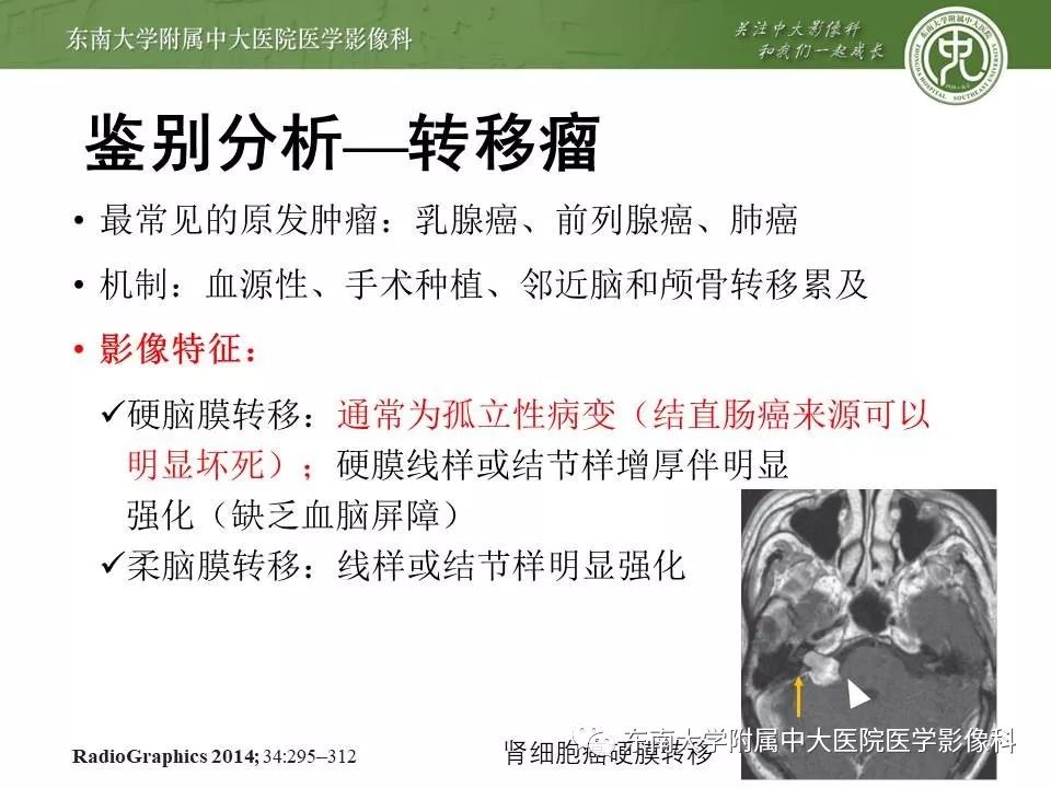 【病例】脑膜瘤伴钙化1例MR影像