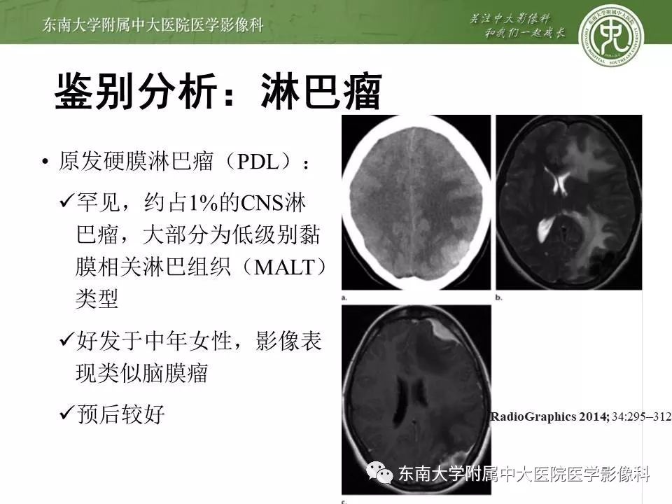 【病例】脑膜瘤伴钙化1例MR影像
