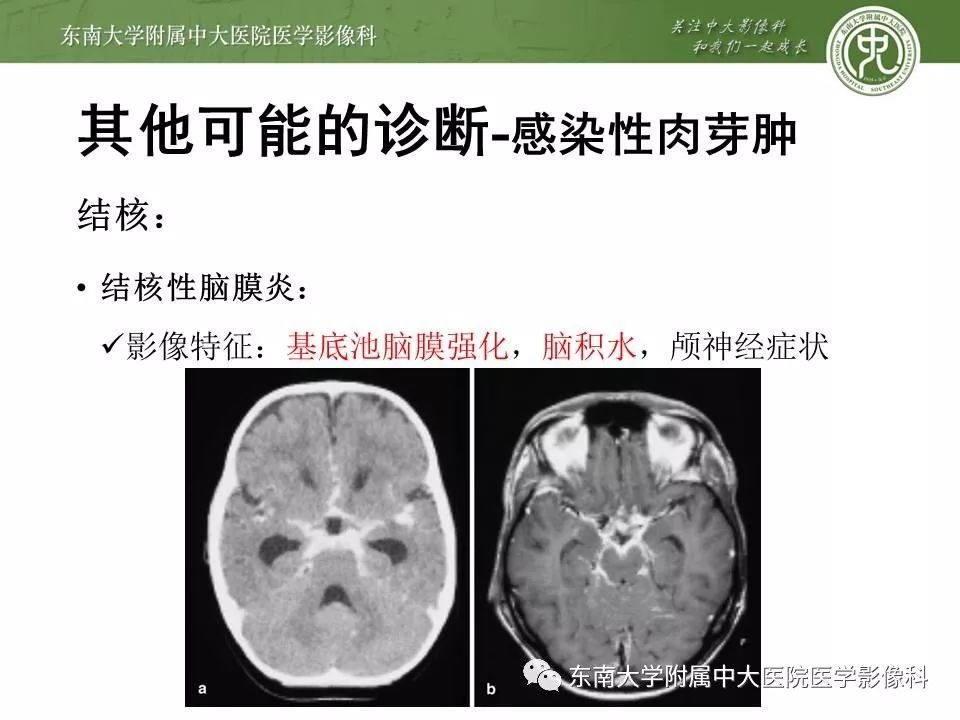 【病例】脑膜瘤伴钙化1例MR影像
