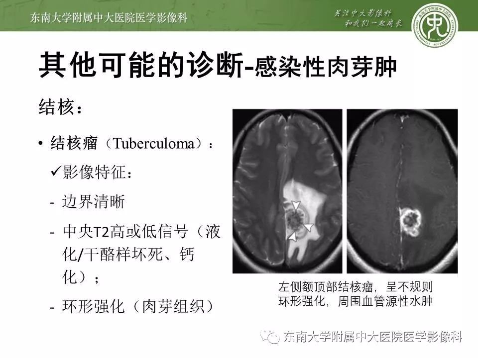 【病例】脑膜瘤伴钙化1例MR影像