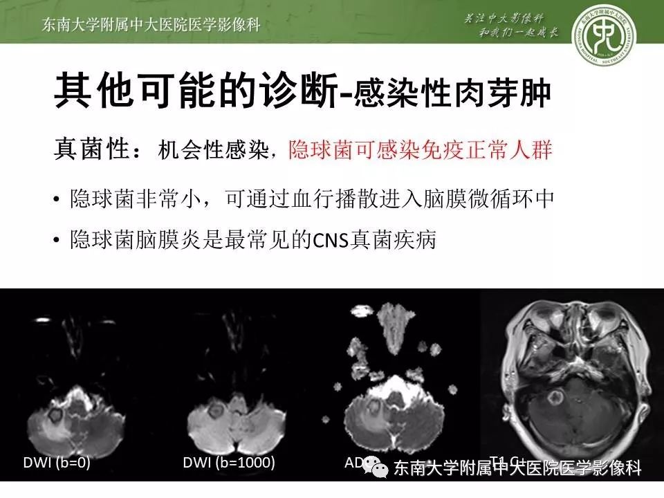 【病例】脑膜瘤伴钙化1例MR影像