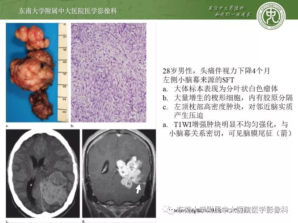 【病例】脑膜瘤伴钙化1例MR影像