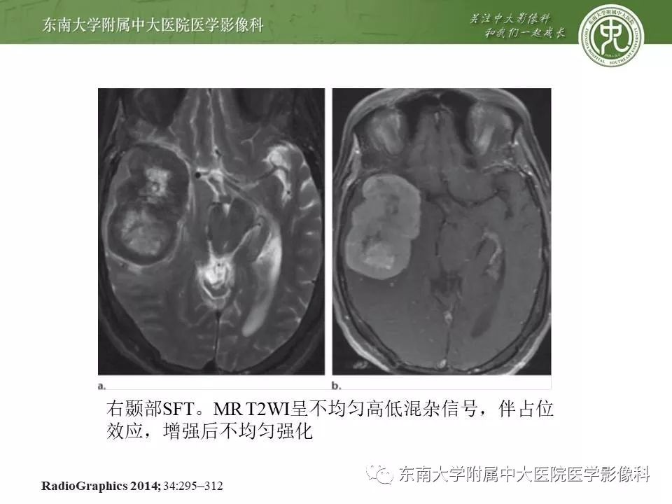 【病例】脑膜瘤伴钙化1例MR影像