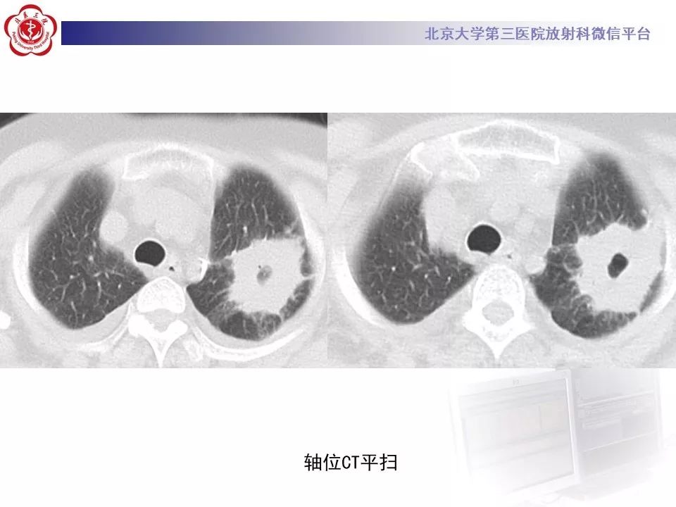 【PPT】肉芽肿性多血管炎/韦格纳肉芽的影像